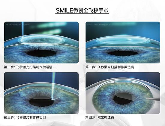蔡司全飛秒、蔡司半飛秒近視手術與蔡司全飛秒flex手術
