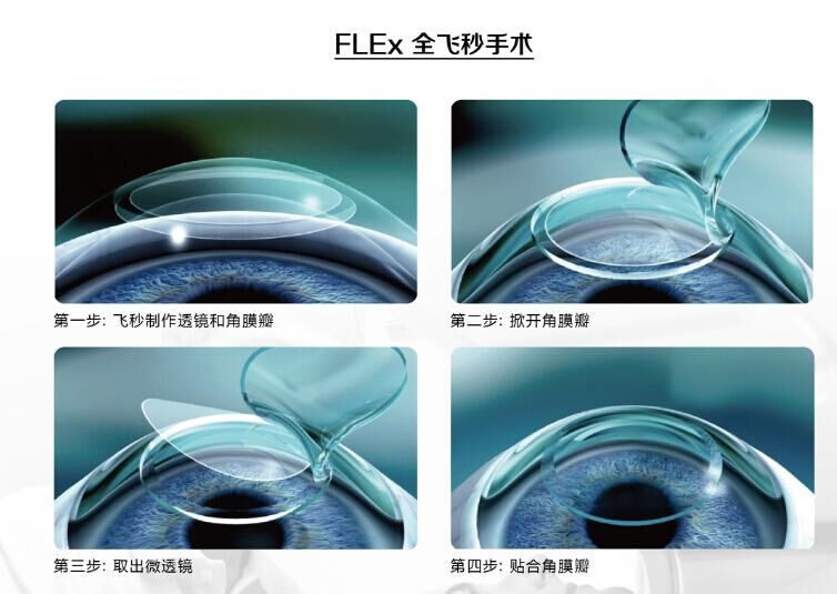 蔡司全飛秒、蔡司半飛秒近視手術與蔡司全飛秒flex手術