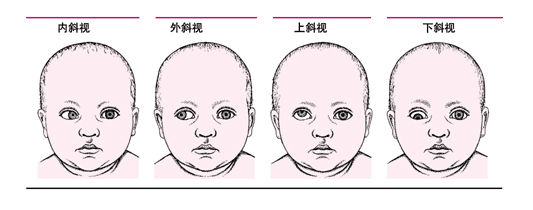 蘭州眼科專家：孩子斜弱視早發現早