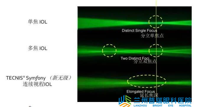 蘭州眼科醫院成功實施新無極變焦晶體植入術