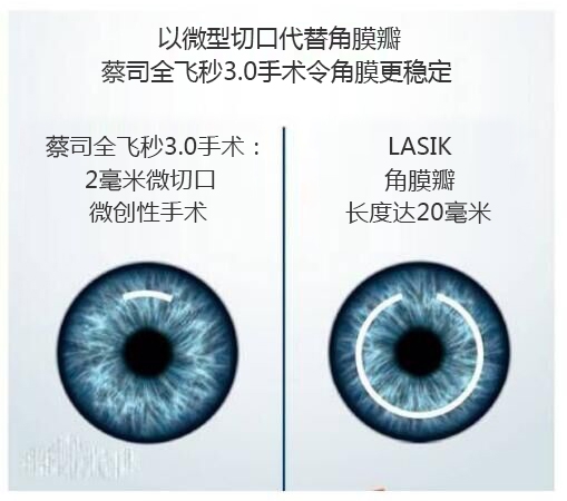 做完近視手術要休息多長時間？需要住院嗎？