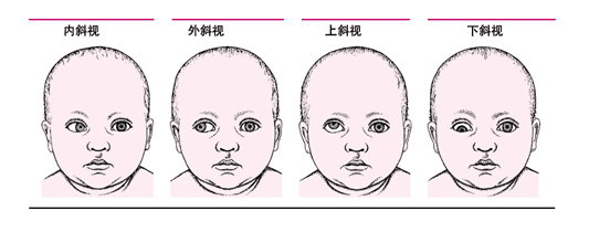 有哪些斜視眼病需要手術