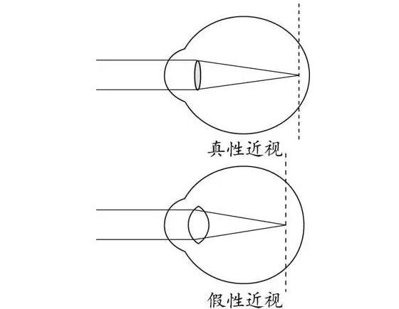 醫學小方法：檢測真性近視還是假性近視