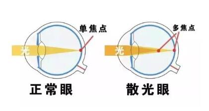 近視和散光，手術(shù)能同時矯正嗎？